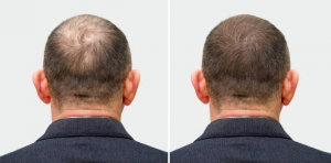 Follicle Fusion: A Journey into Advanced Hair Restoration in Riyadh